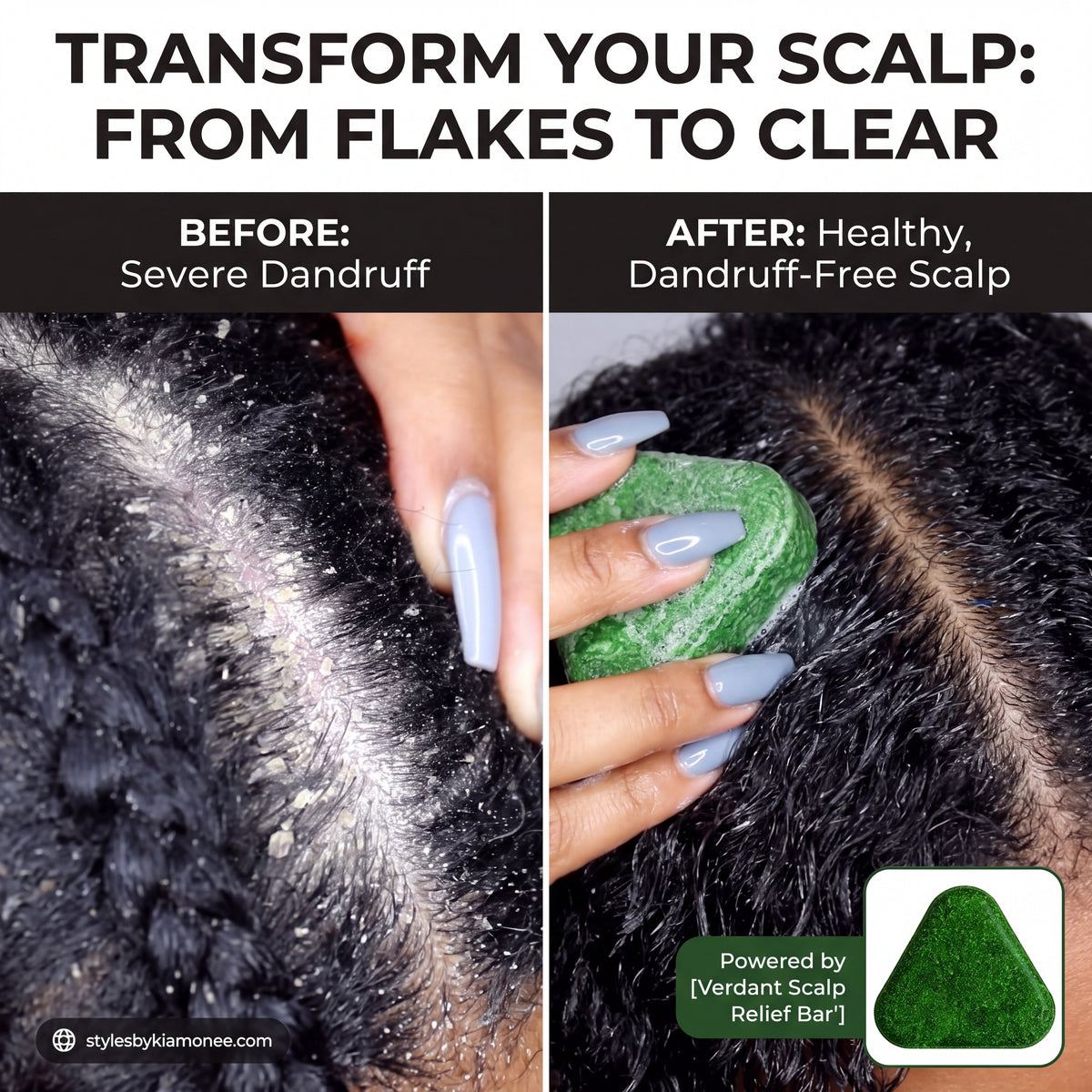 ScalpRevive™ – Hair Growth & Anti-dandruff Soap